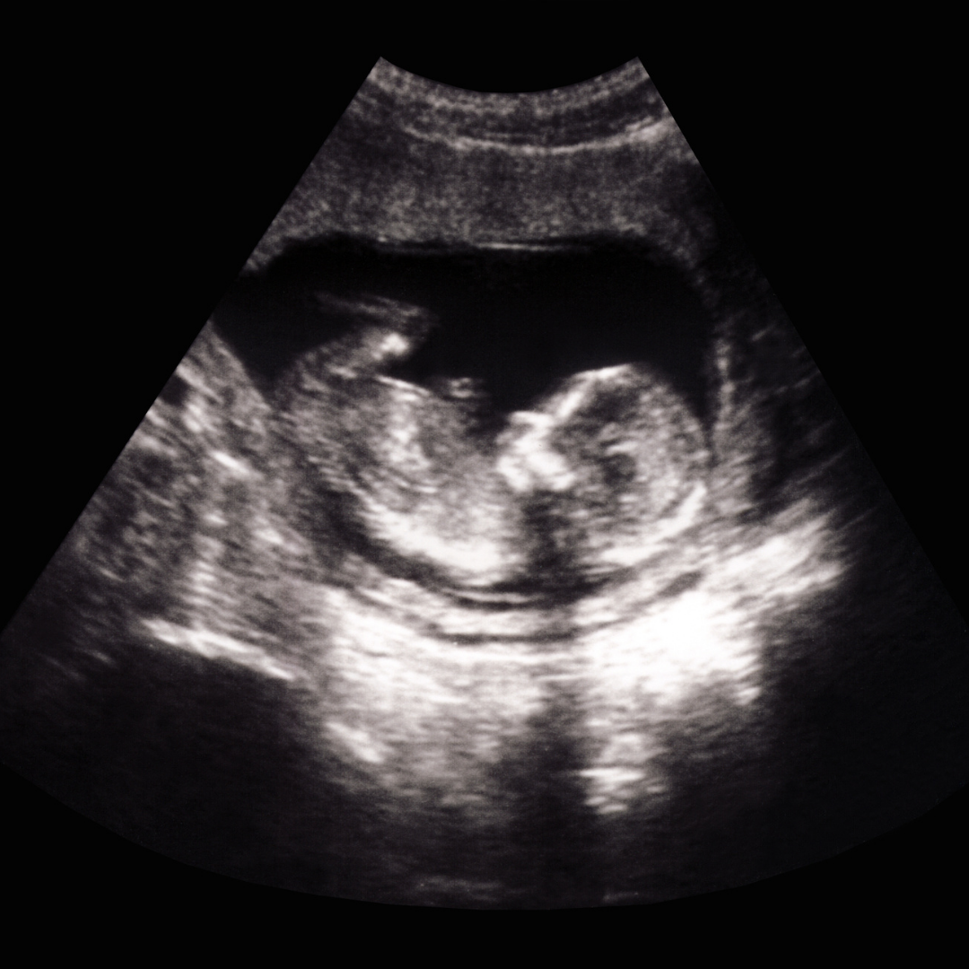 ultrasound image of baby in early pregnancy