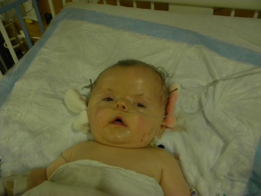 My daughter, following her cranial vault reconstruction surgery.