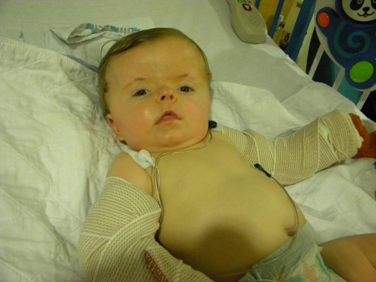 Sarah after her first orthopedic surgery.